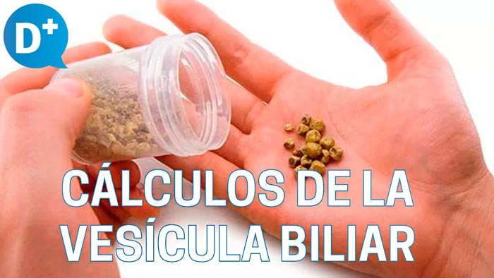 Causas y síntomas de los cálculos de la vesícula biliar - Destaca2